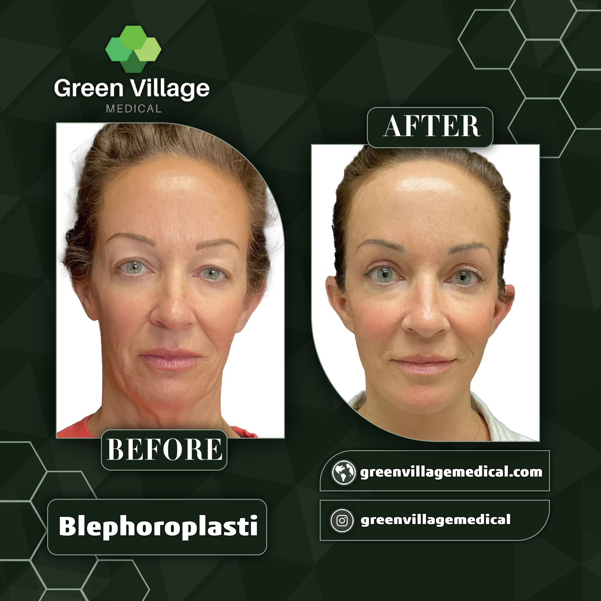 Блефаропластика