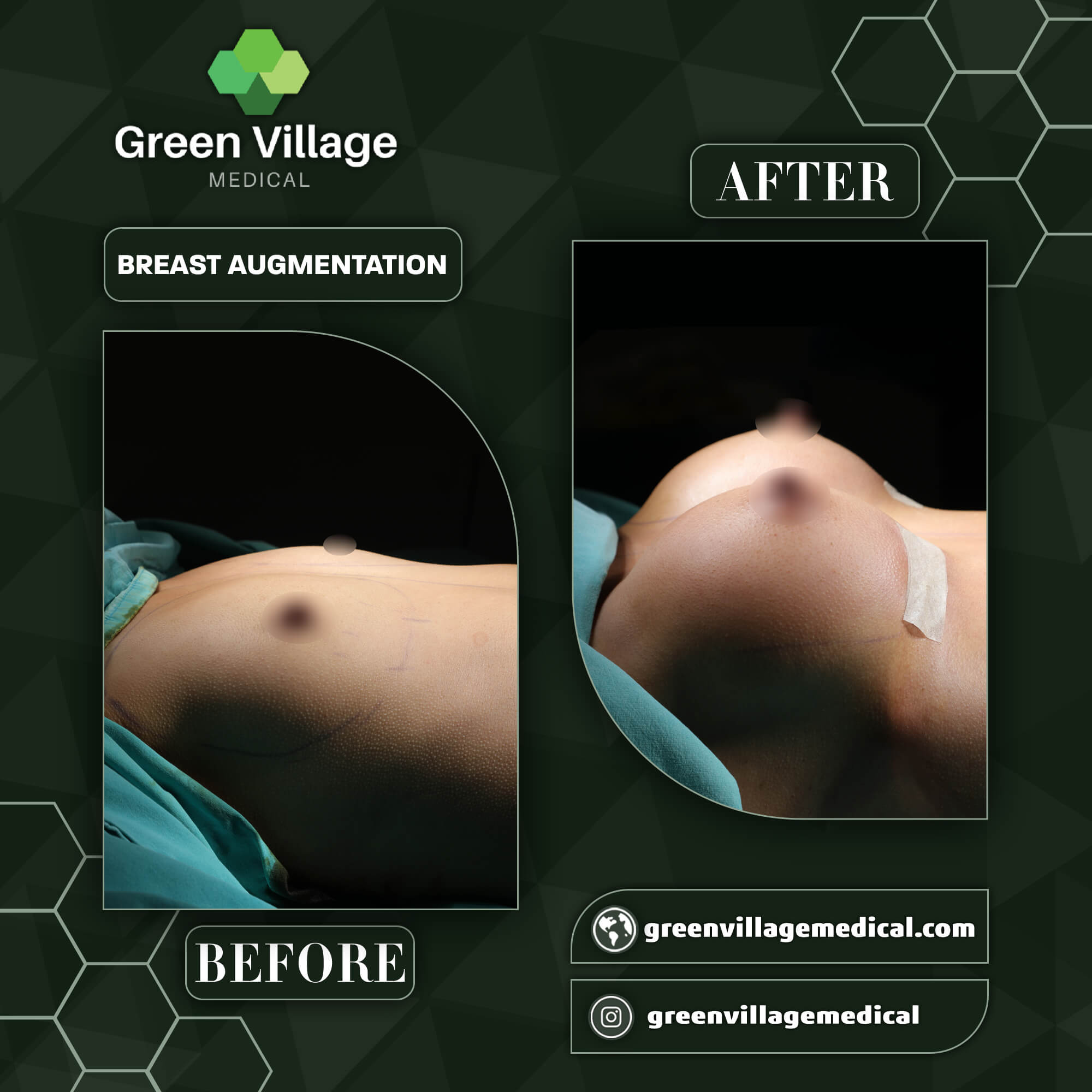 Увеличение груди