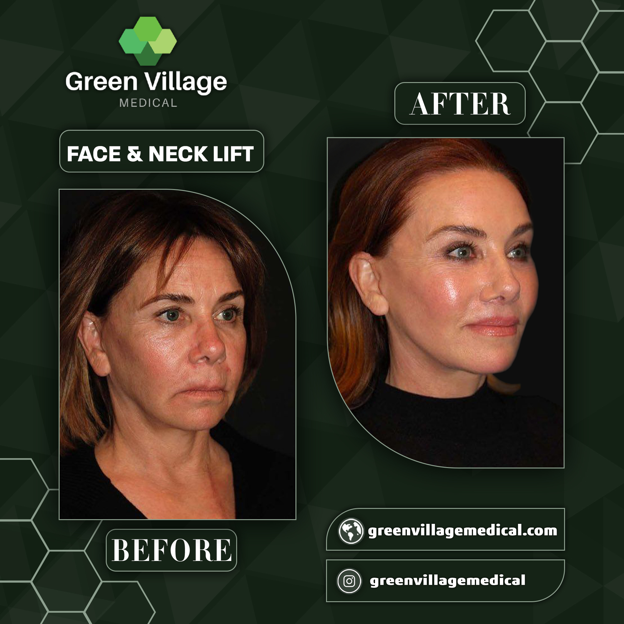 Фейслифтинг