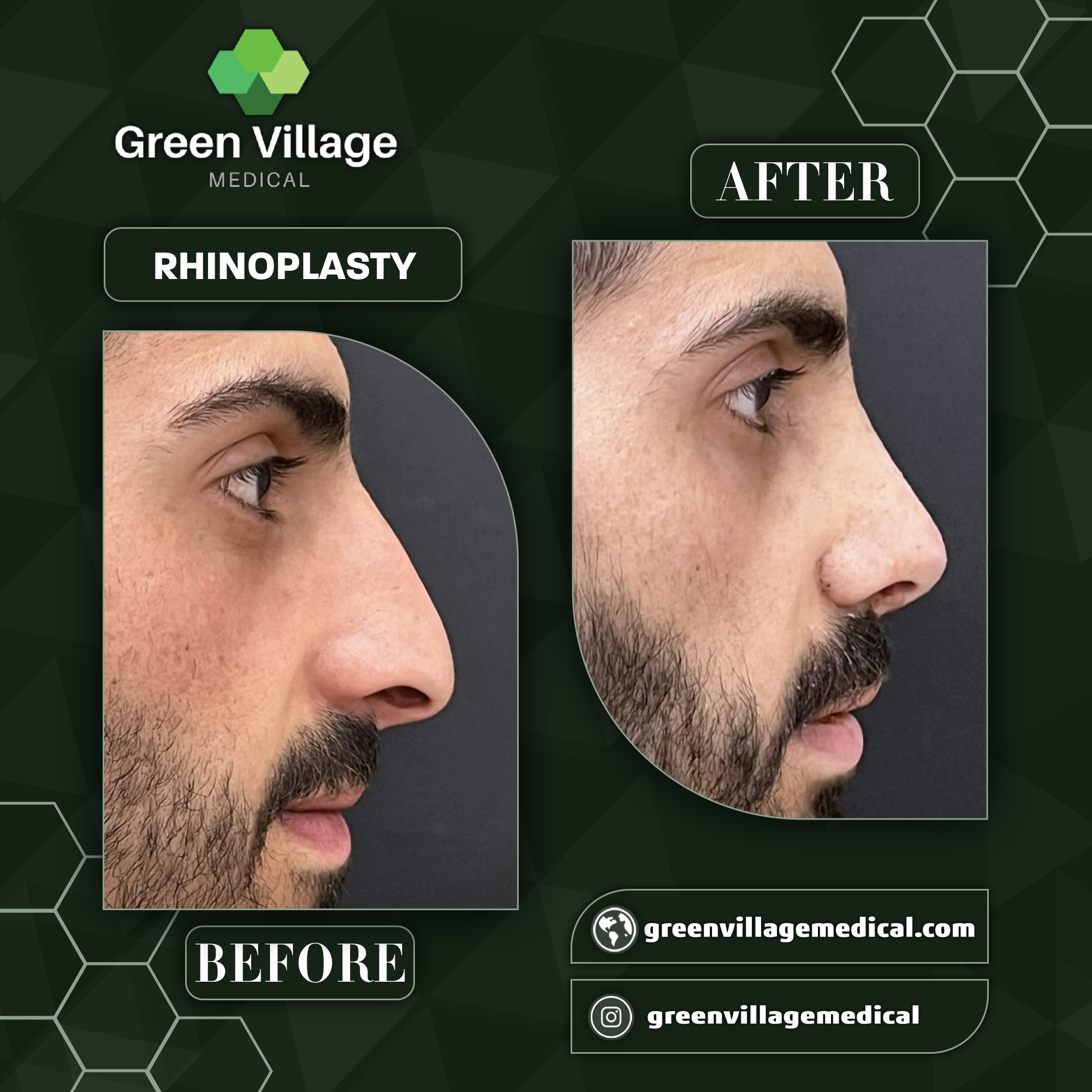 Ринопластика