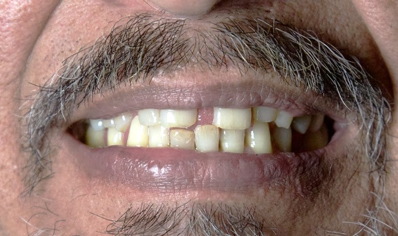 hollywood smile before