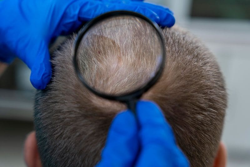 Hair Transplants For Baldness