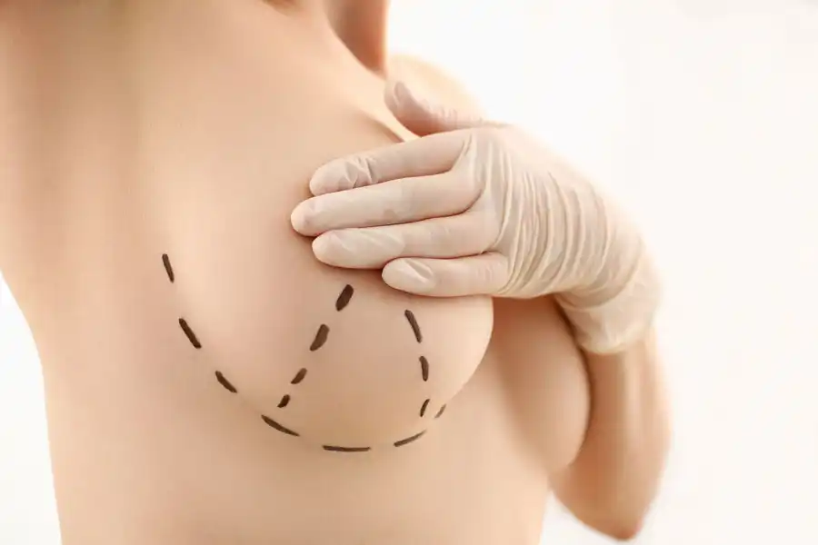 before and after breast augmentation surgery