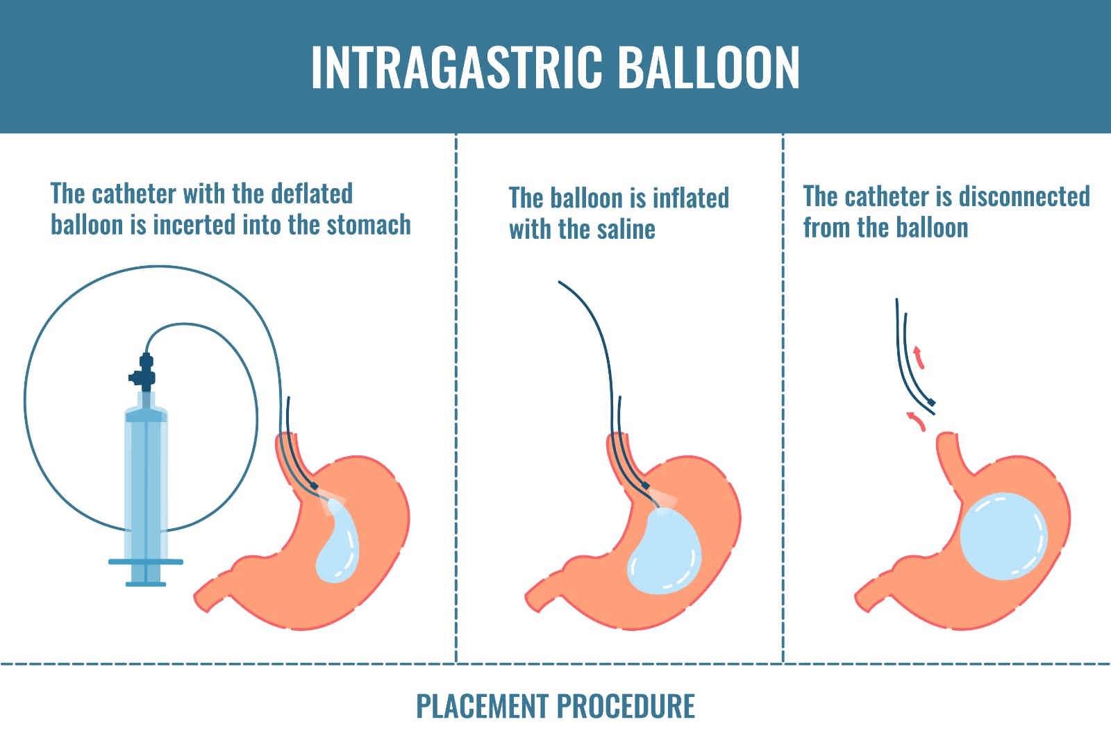 intragastric baloon surgery