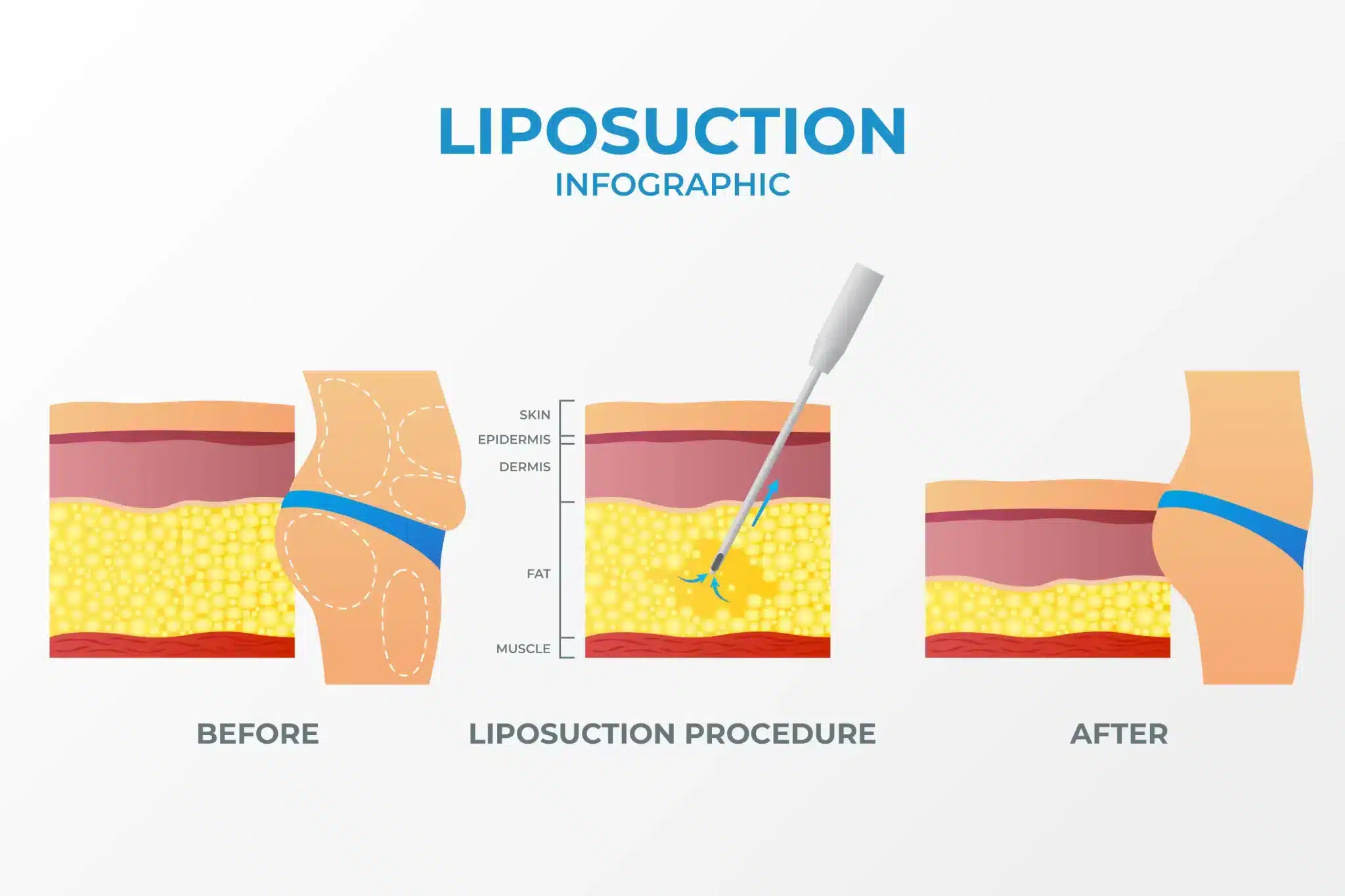 liposuction