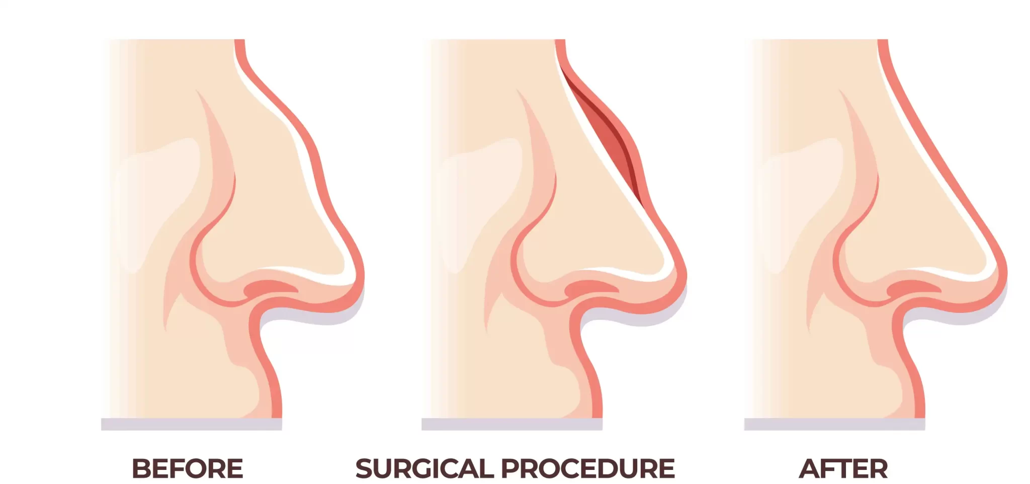 rhinoplasty