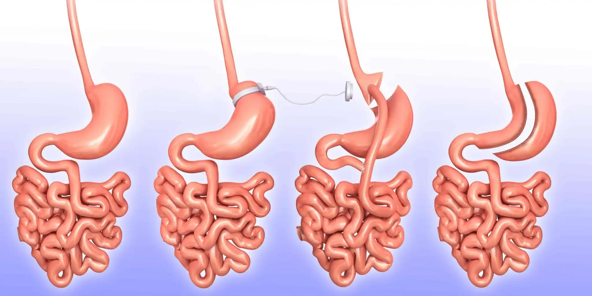 bariatric surgery