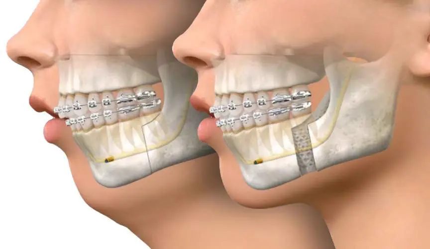 jaw surgery