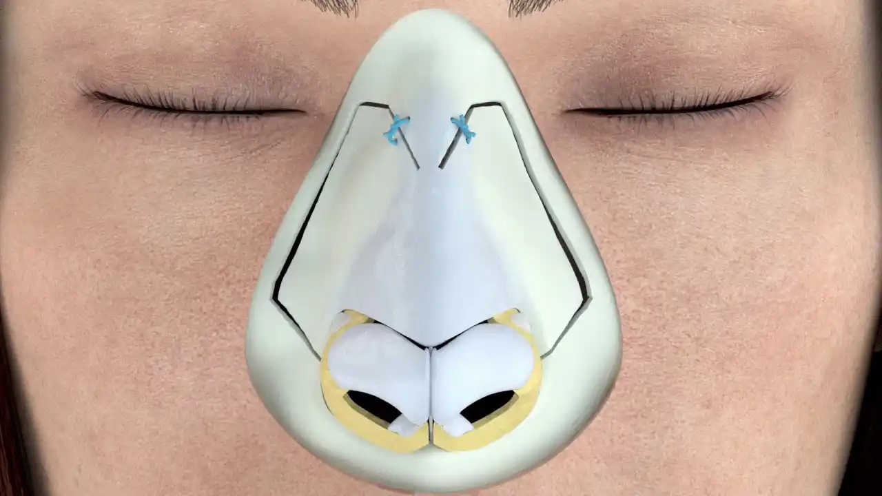 ultrasonic rhinoplasty