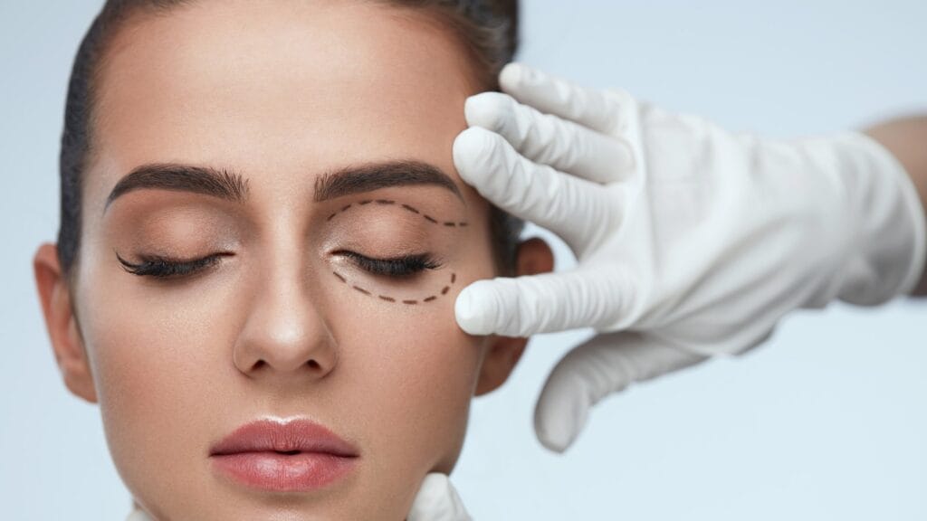 blepharoplasty