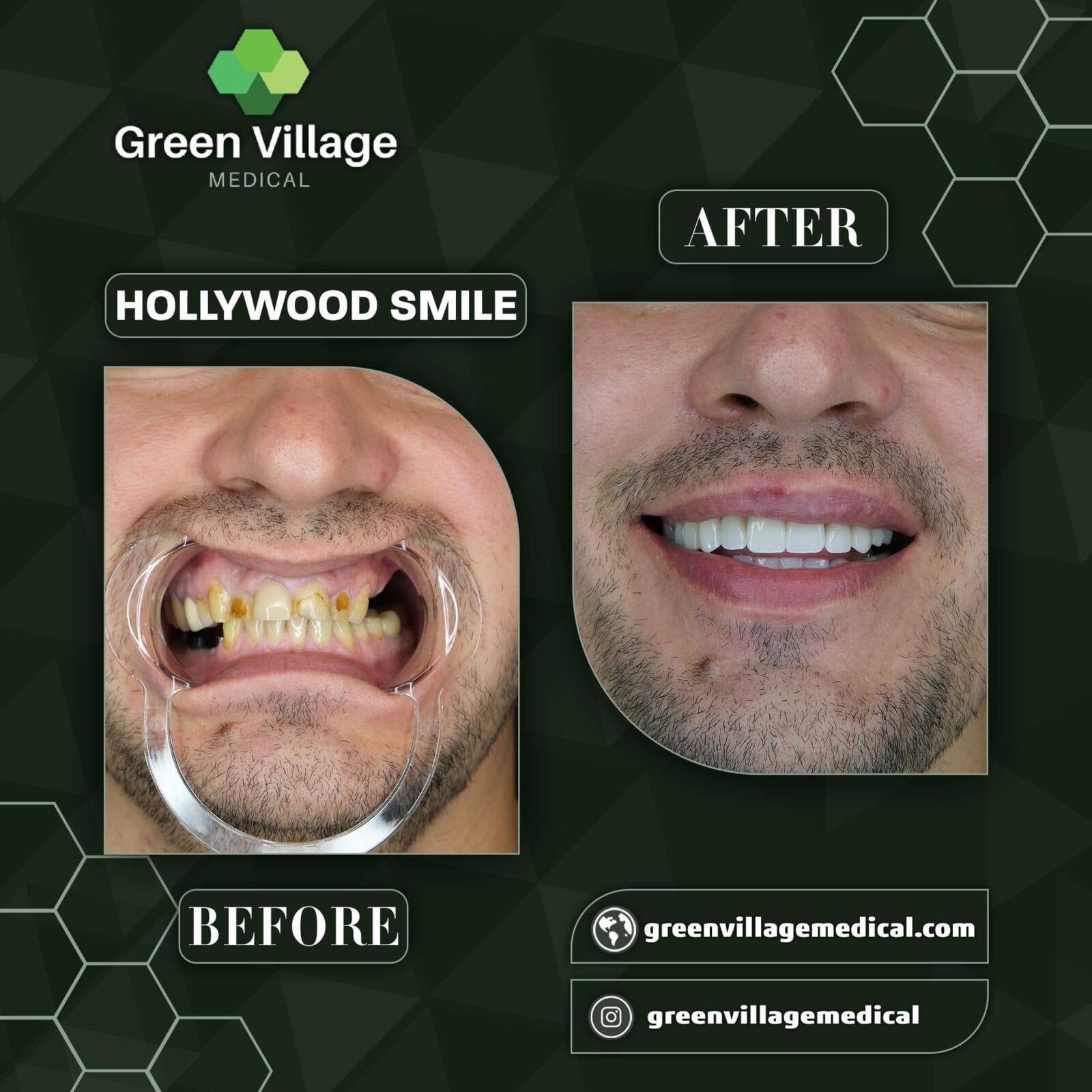 Hollywood Smile