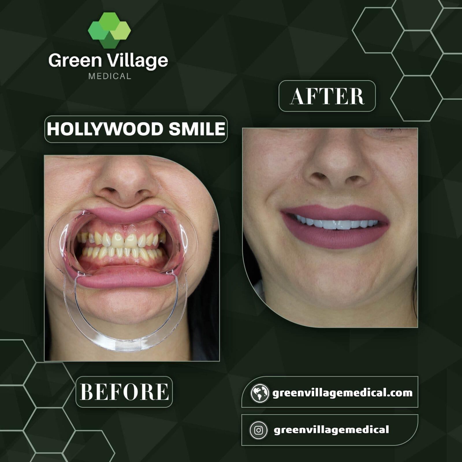Hollywood Smile