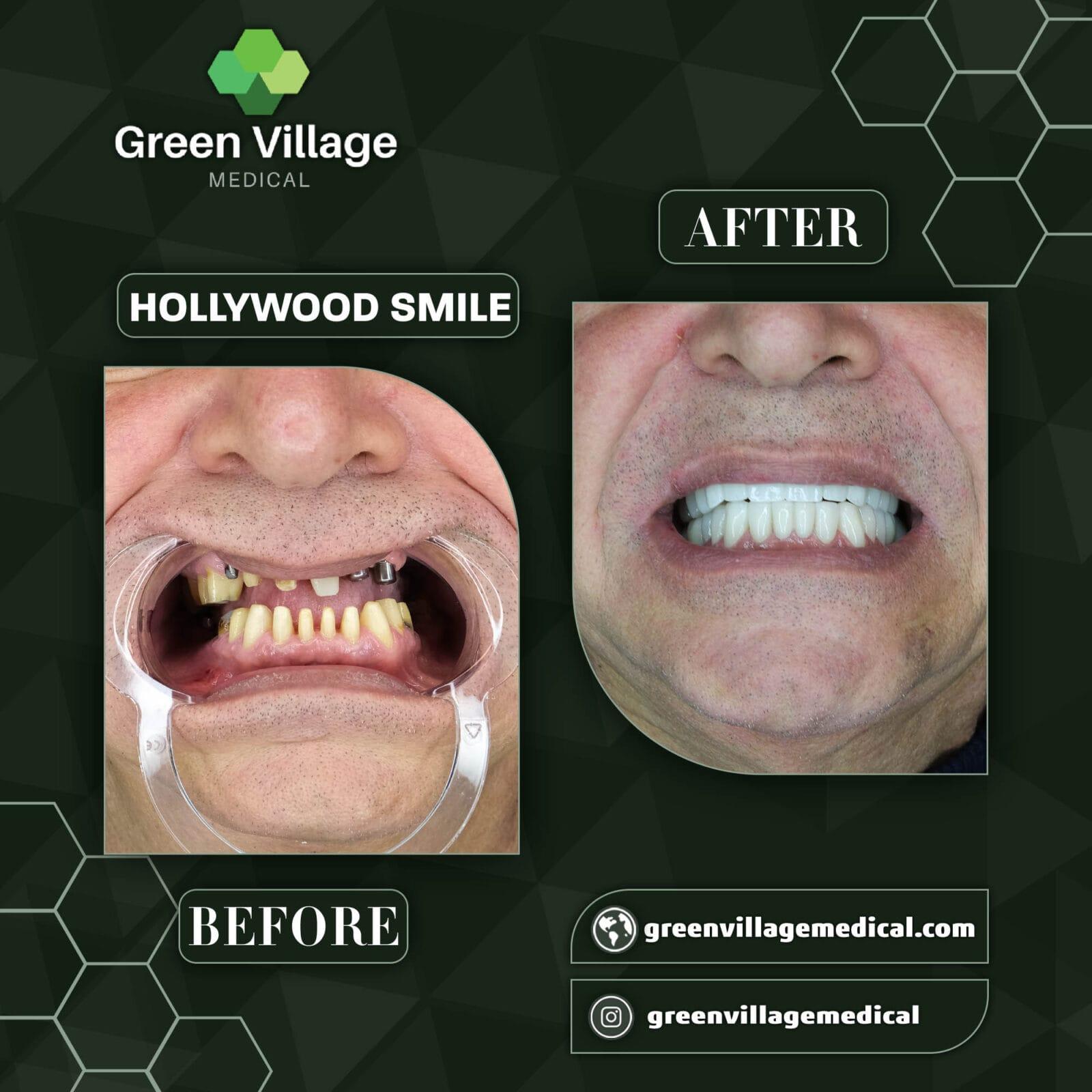 Hollywood Smile