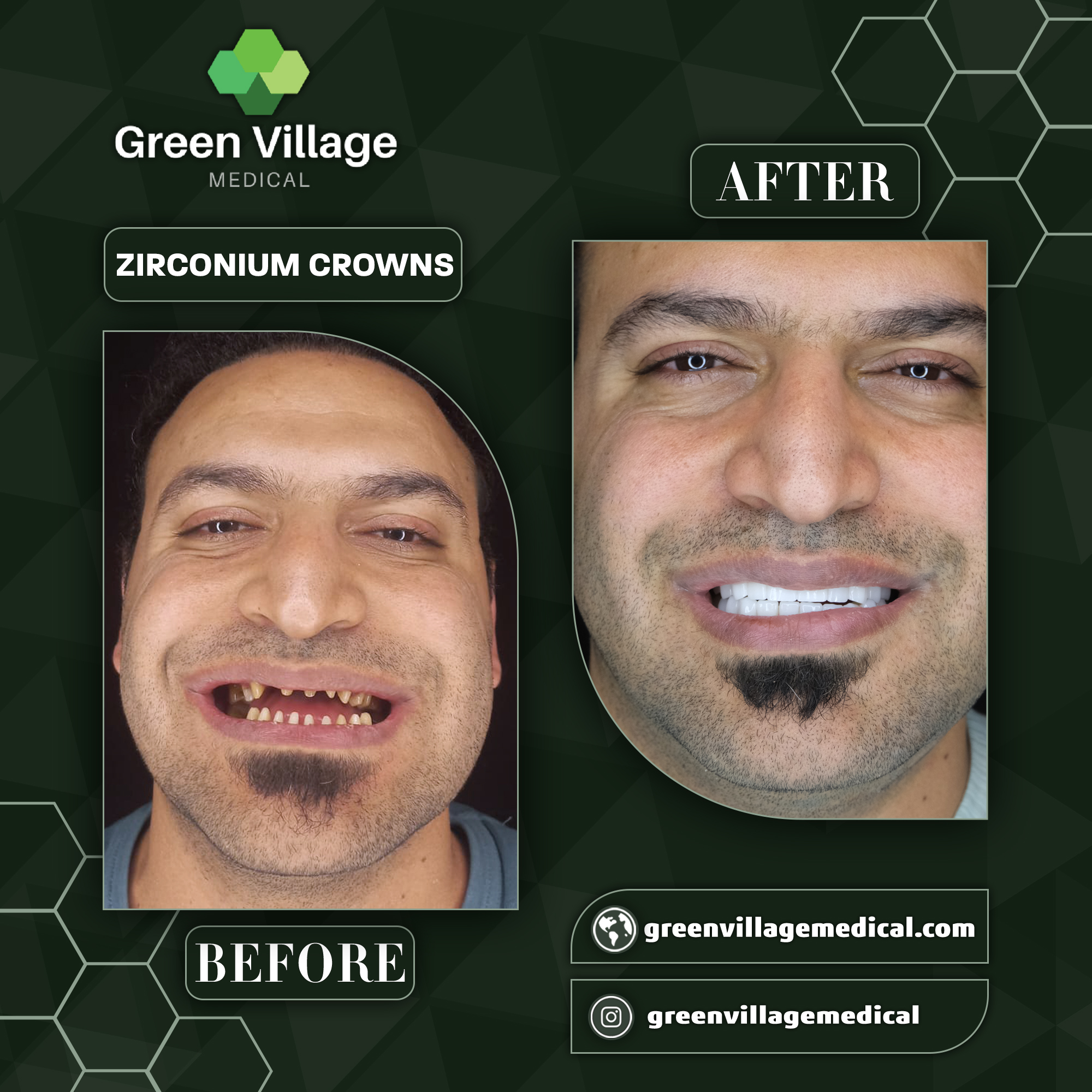 Zirconium Crowns Before After 2