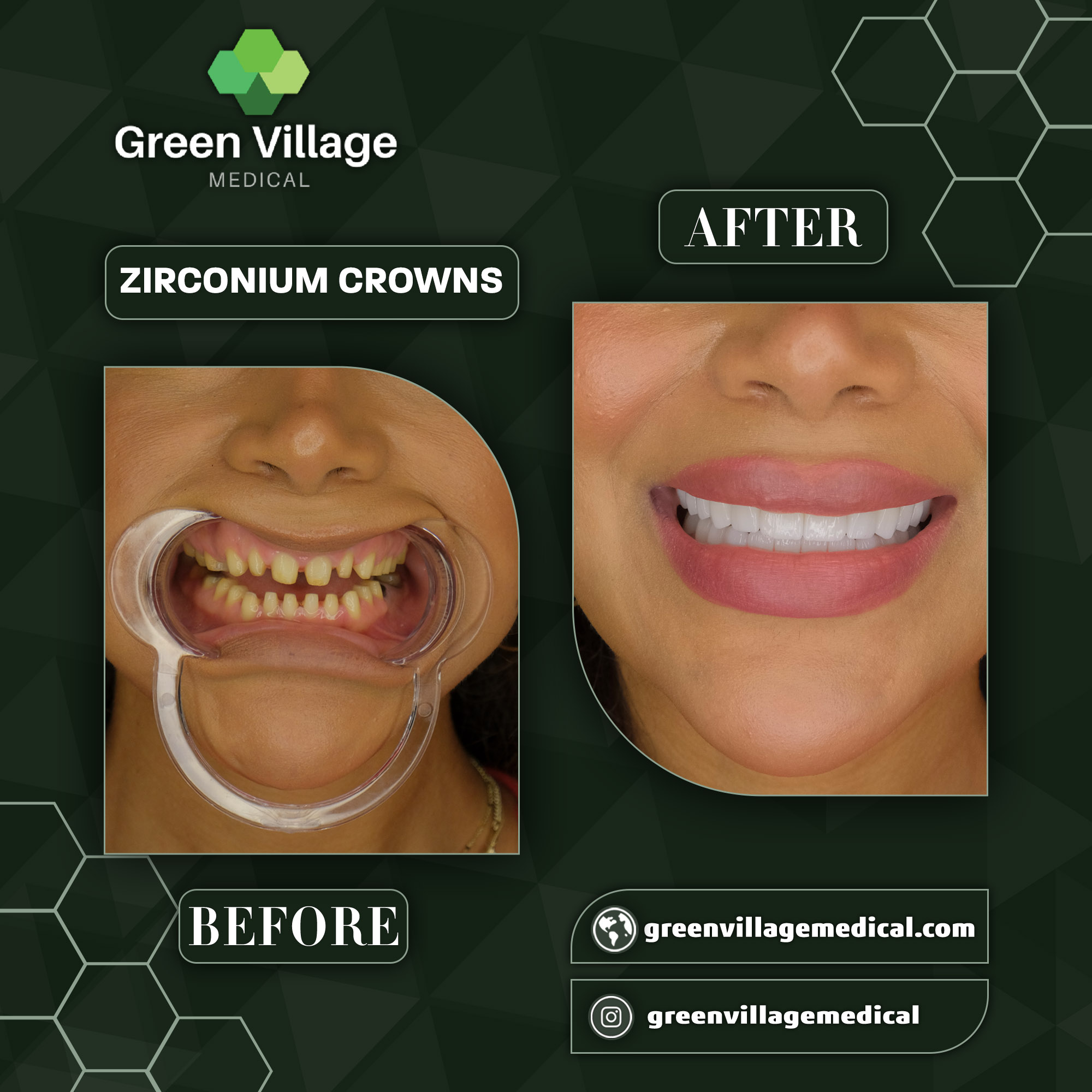 Zirconium Crowns Before After