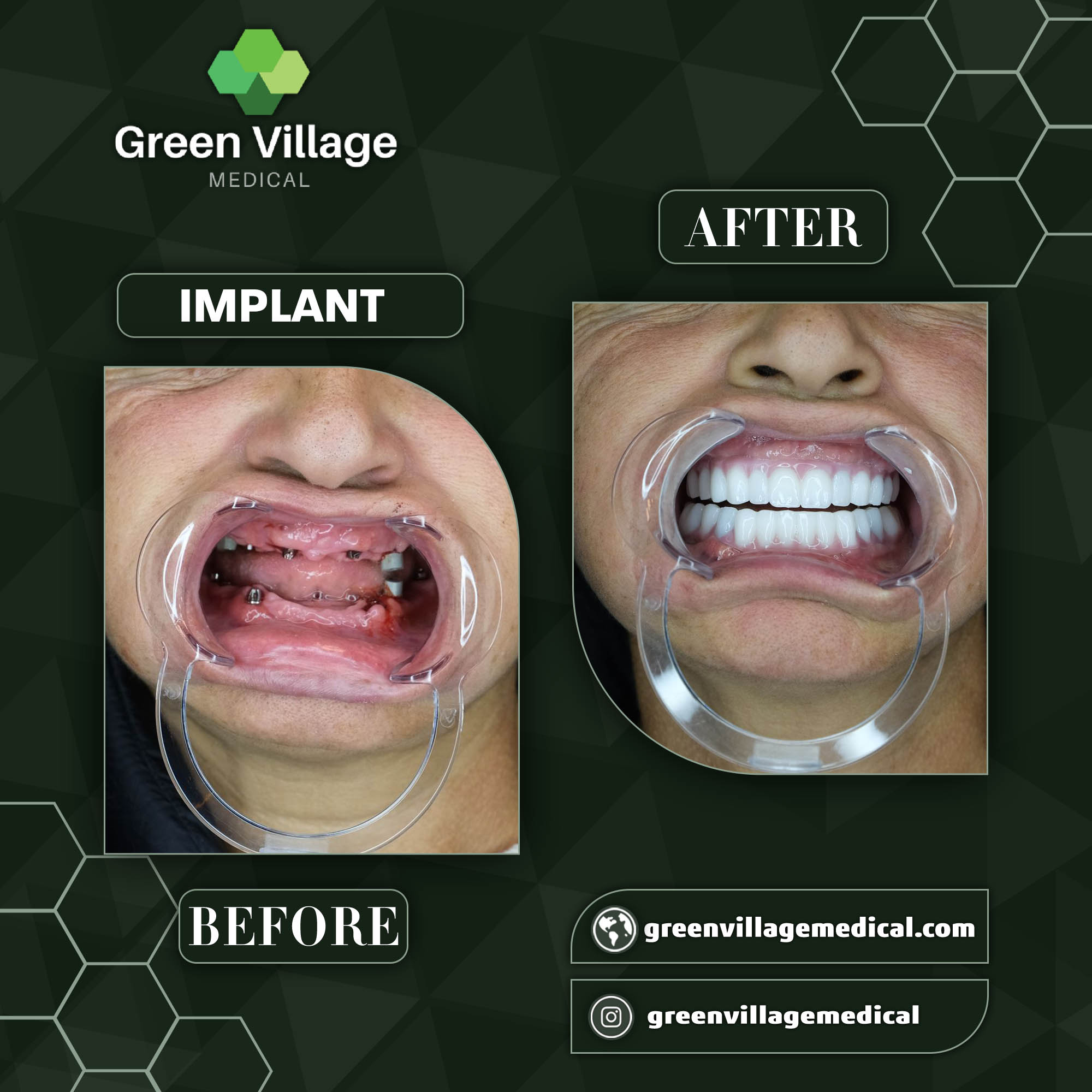 Implant Before After 2