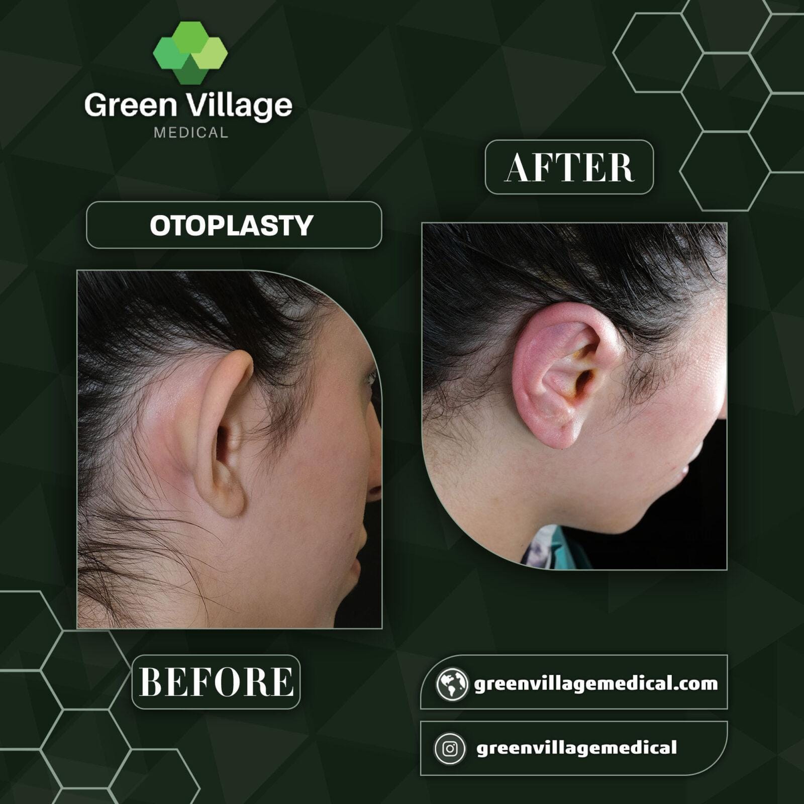 Before After 1