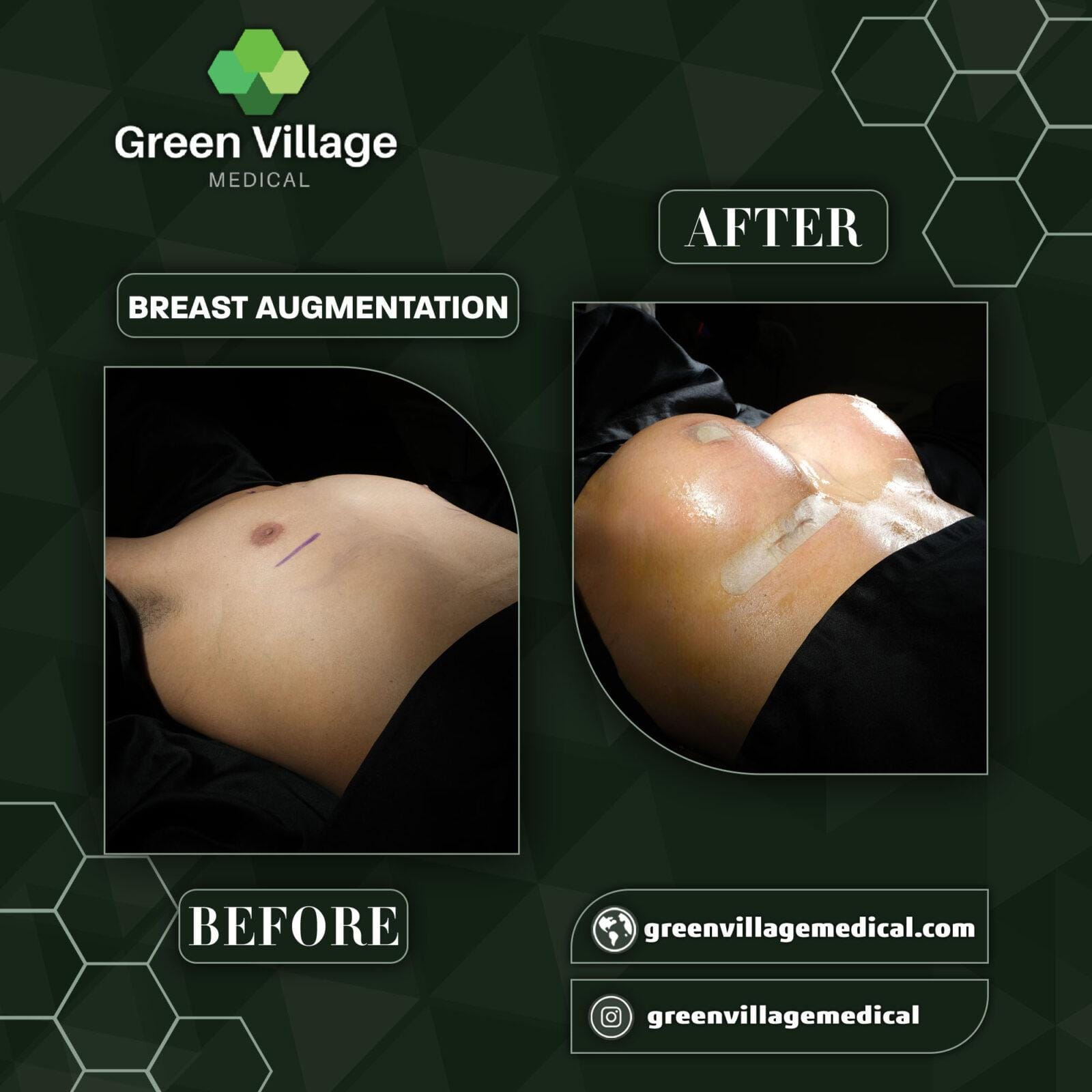 Before After 1
