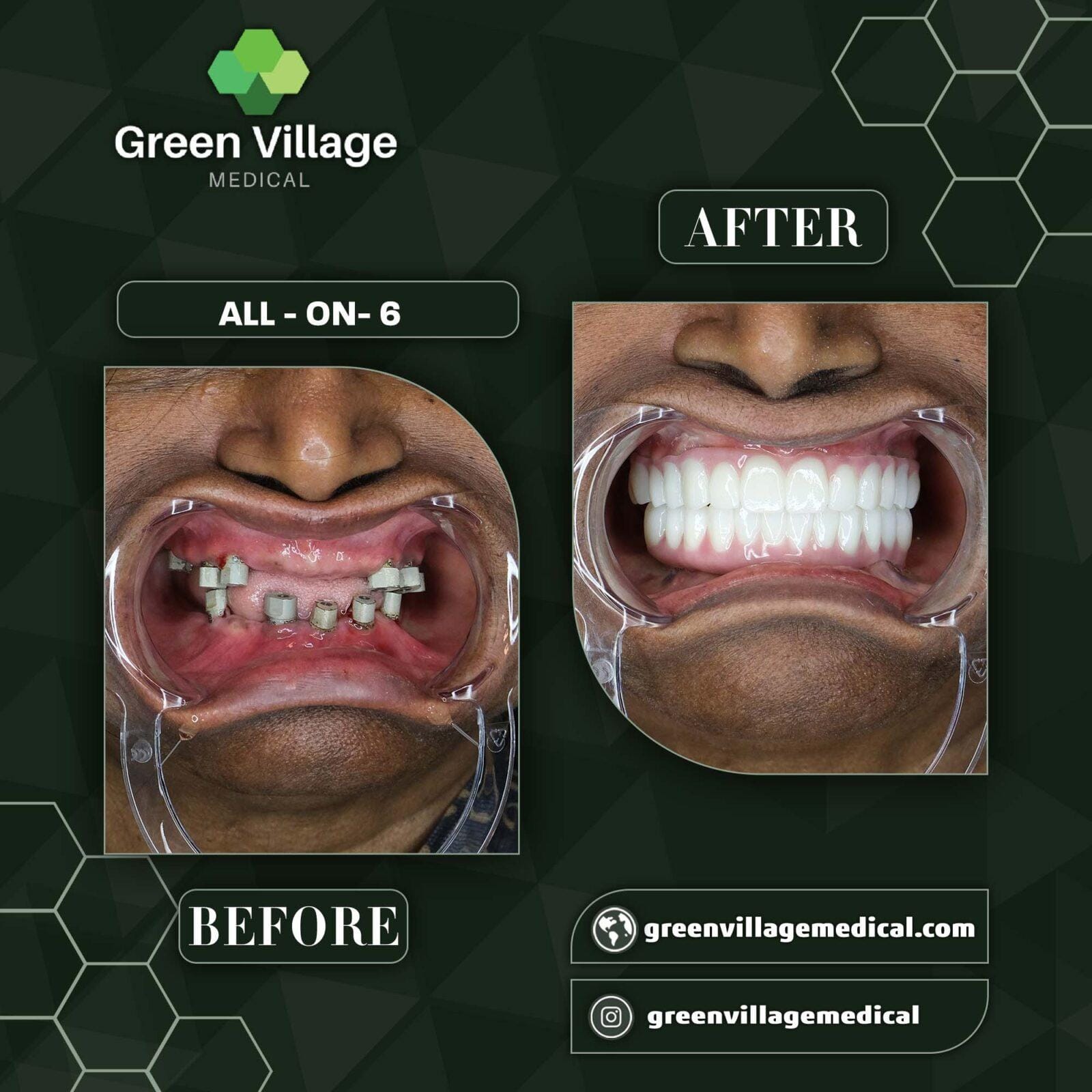 Before After 10