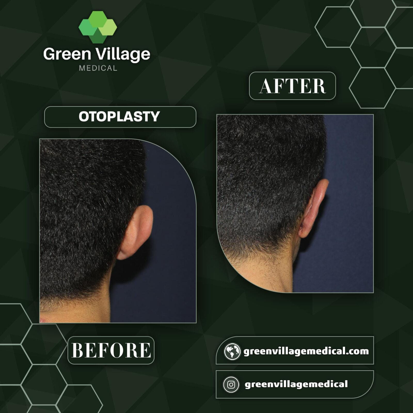 Before After 10