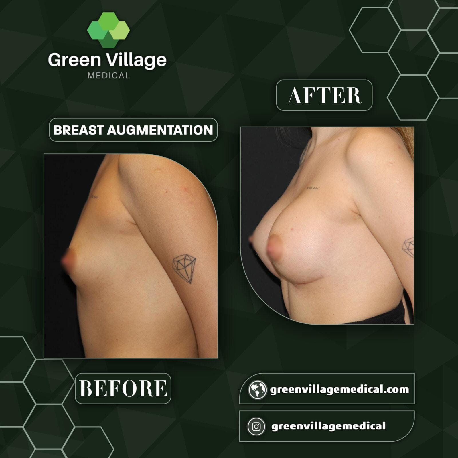 Before After 12