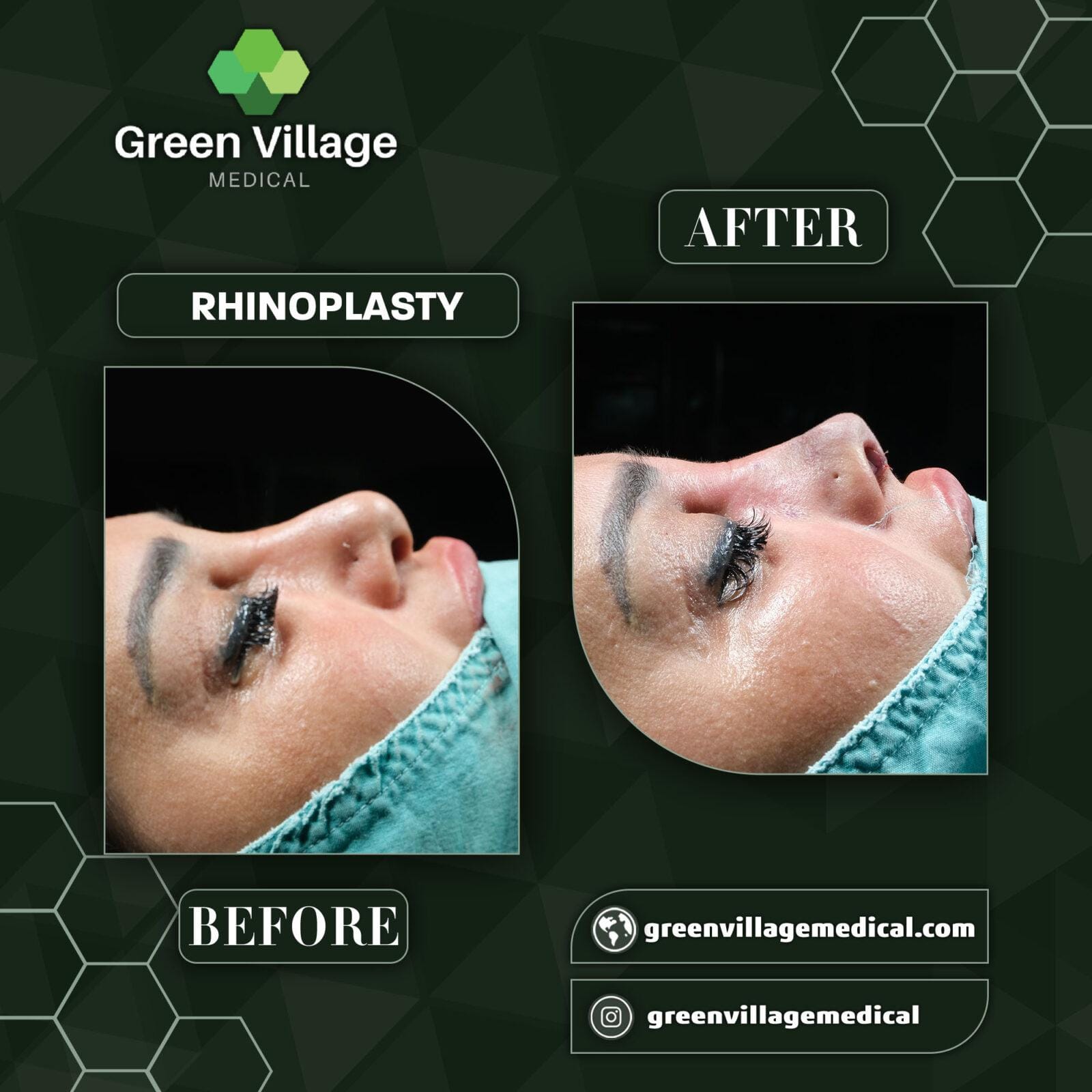 Before After 2