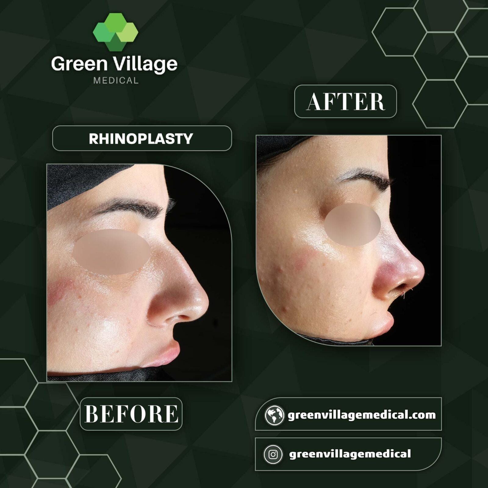 Before After 2