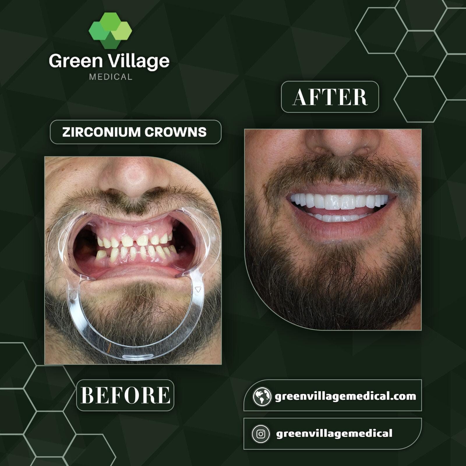Before After