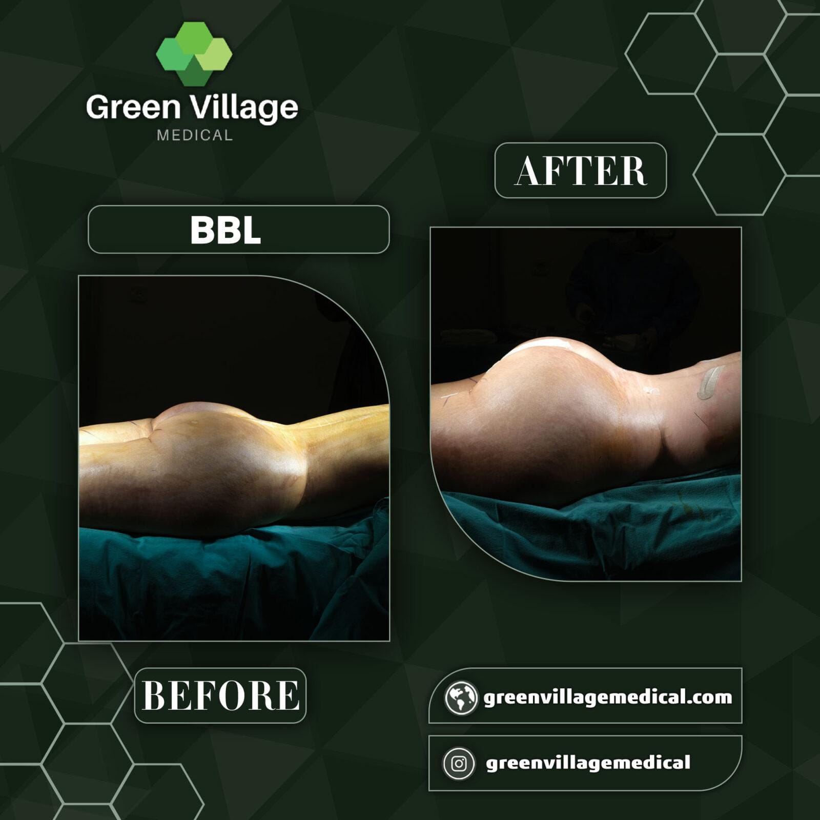 Before After 2