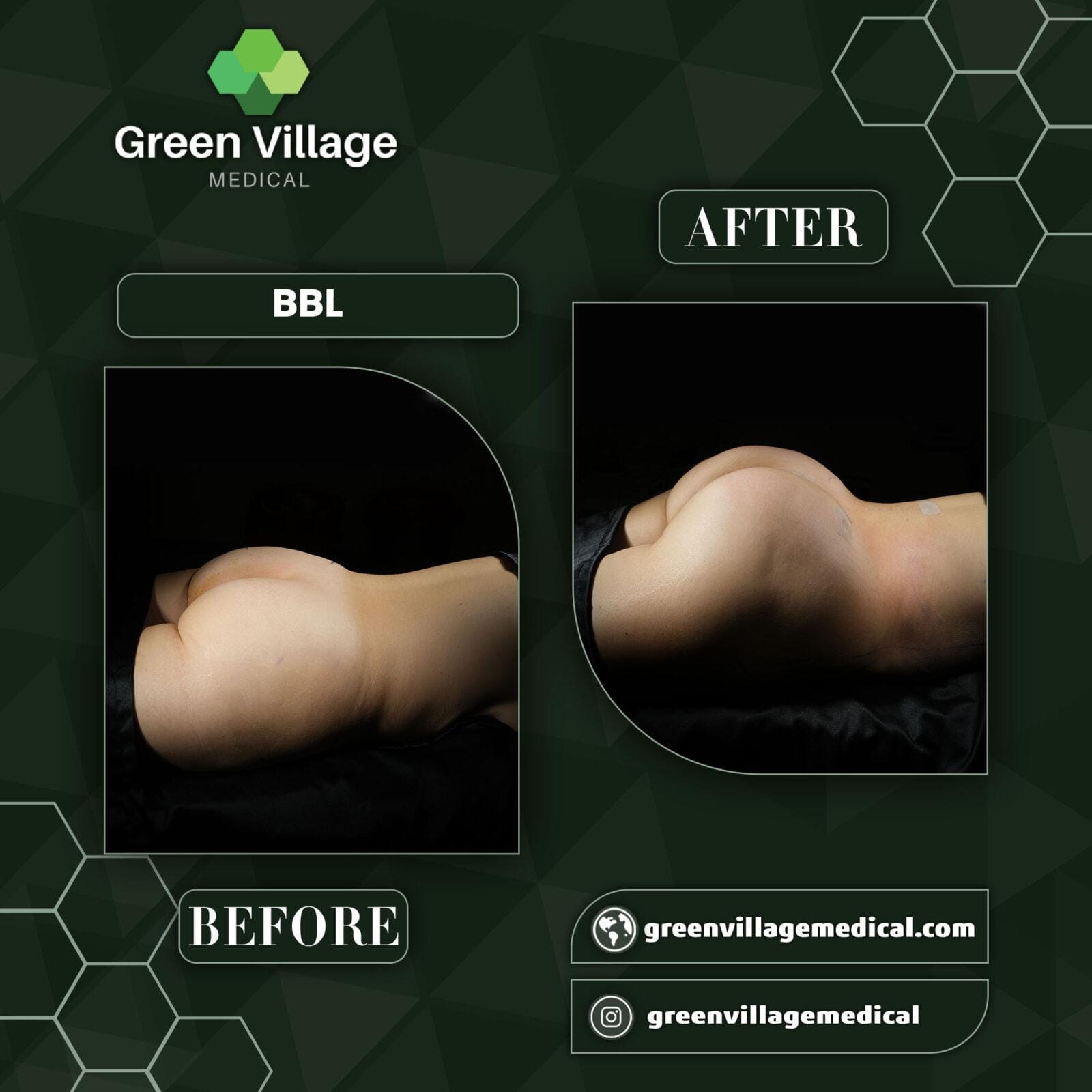 Before After 3