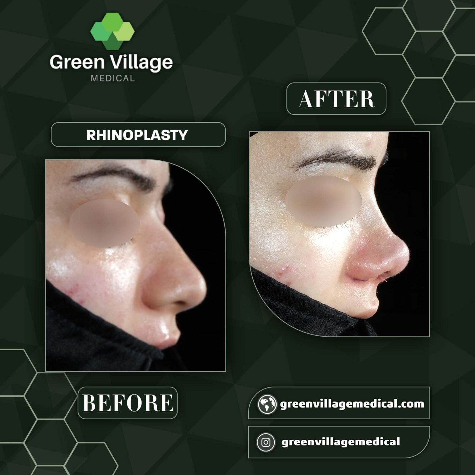 Before After 3