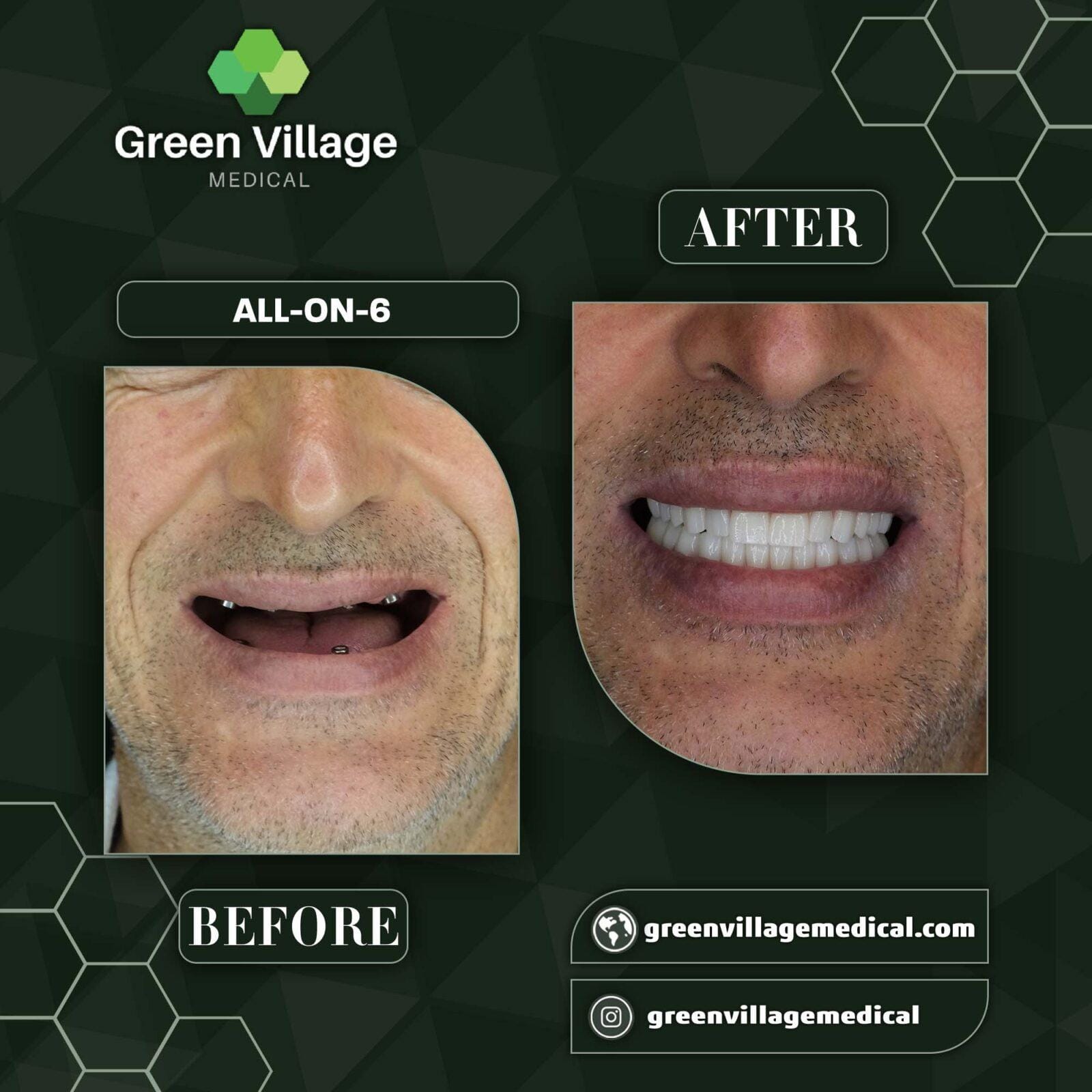 Before After 3