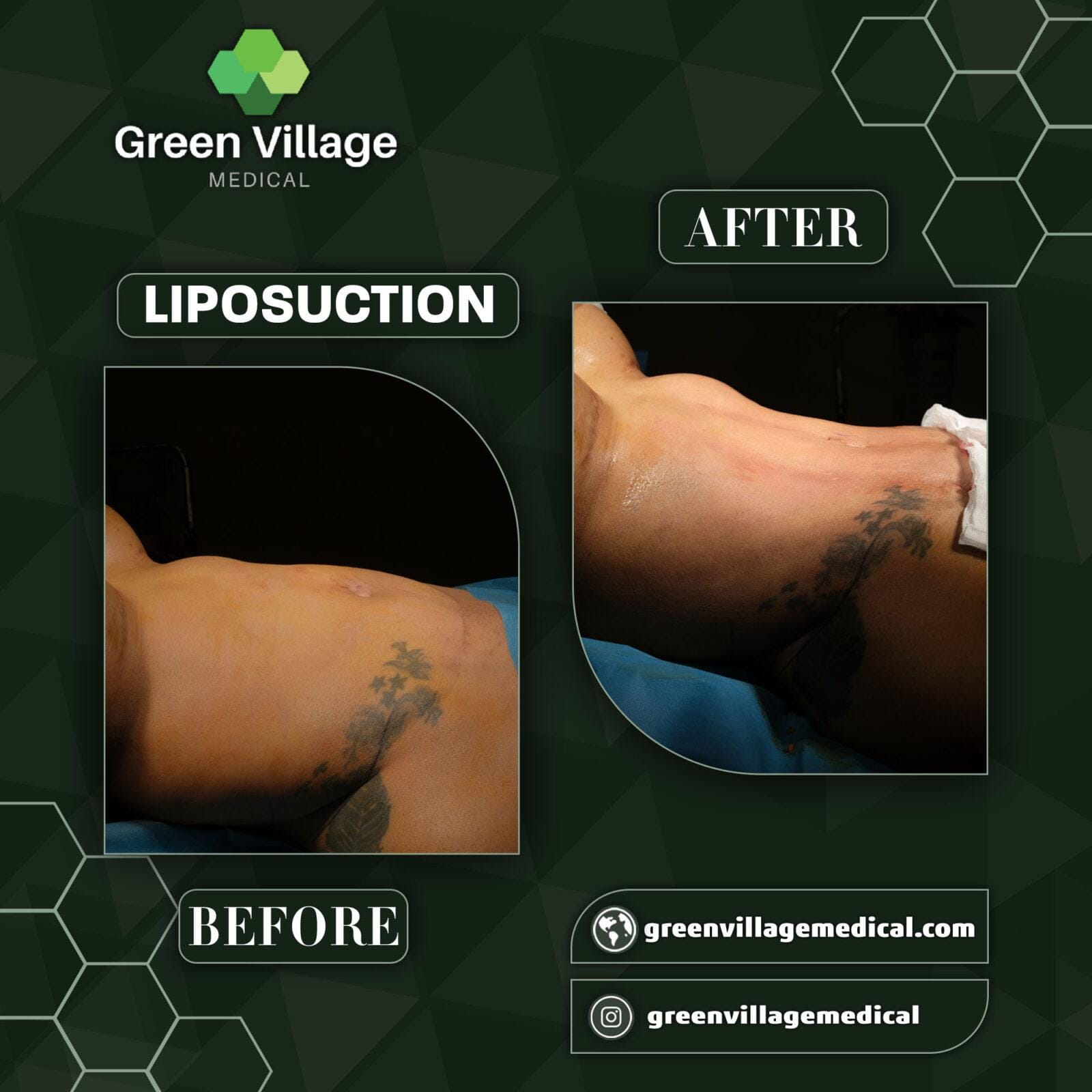 Before After 3