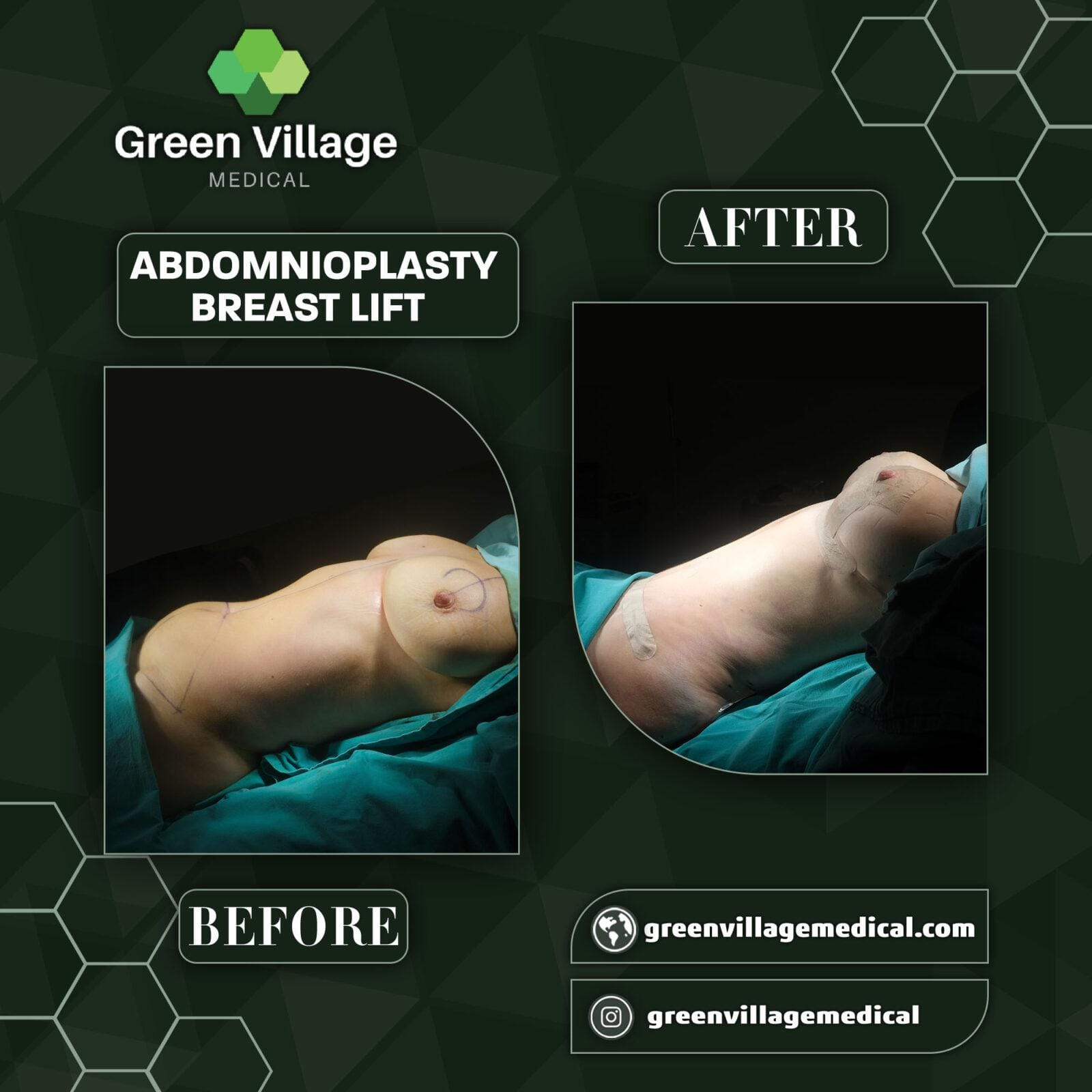 Before After 4
