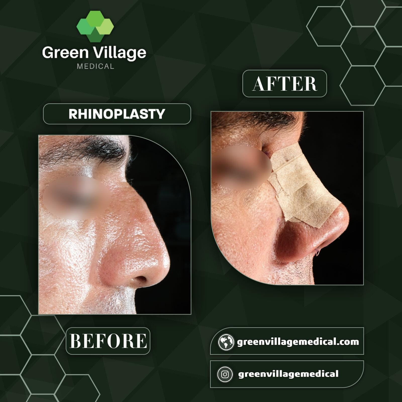 Before After 4