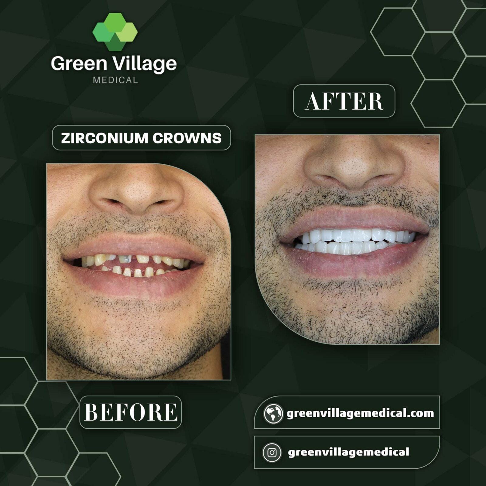 Before After 4