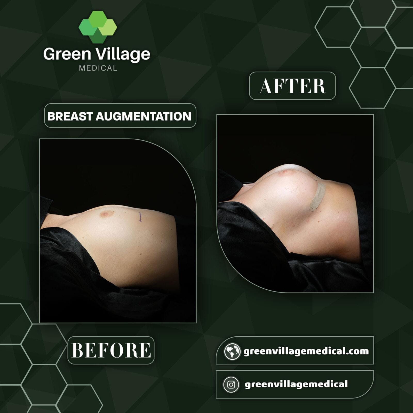 Before After 4