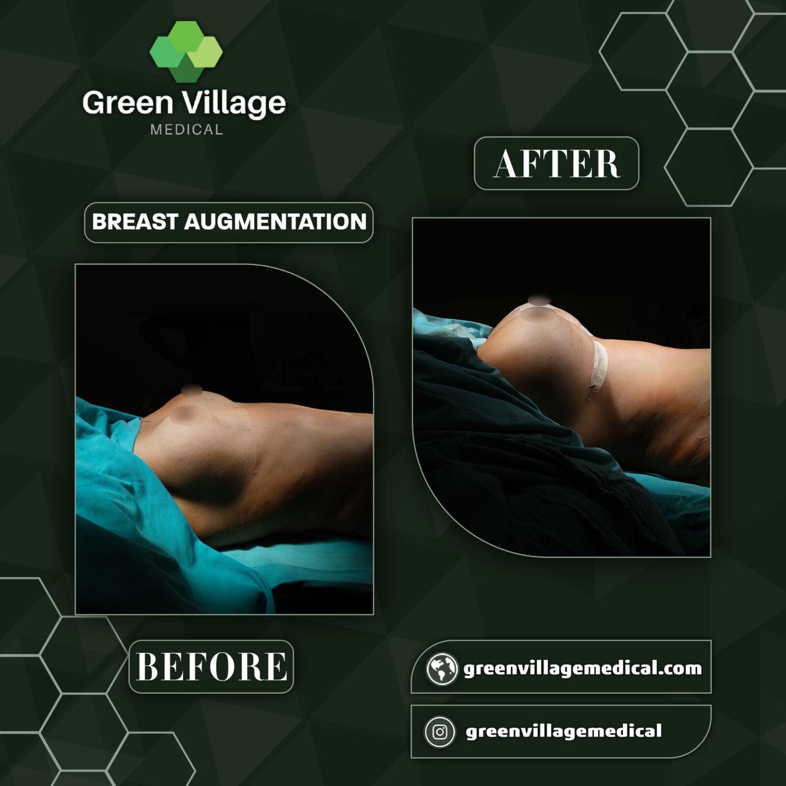 Before After 5