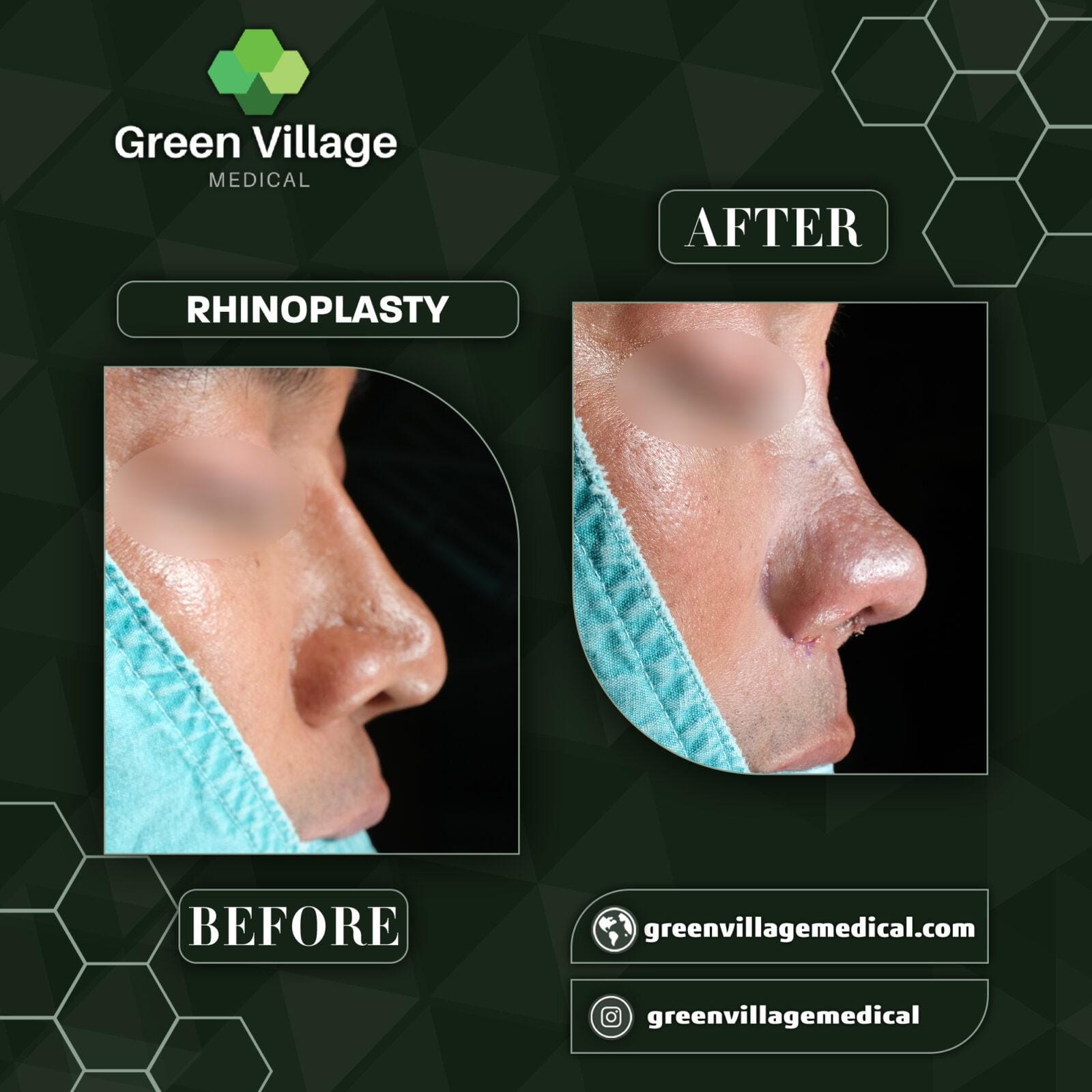 Before After 5