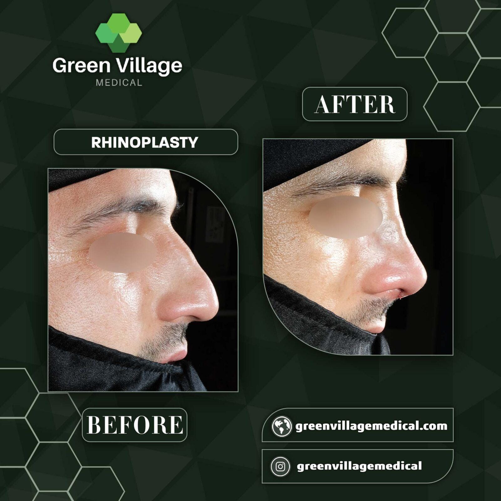Before After 5