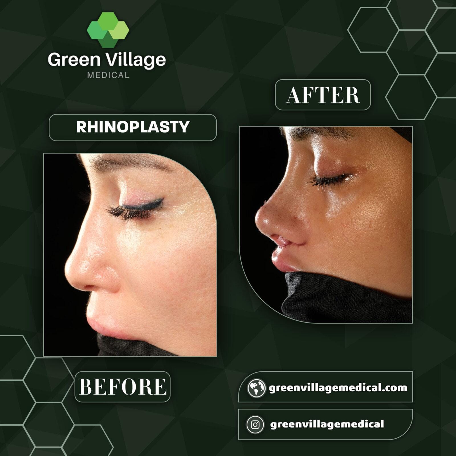 Before After 5