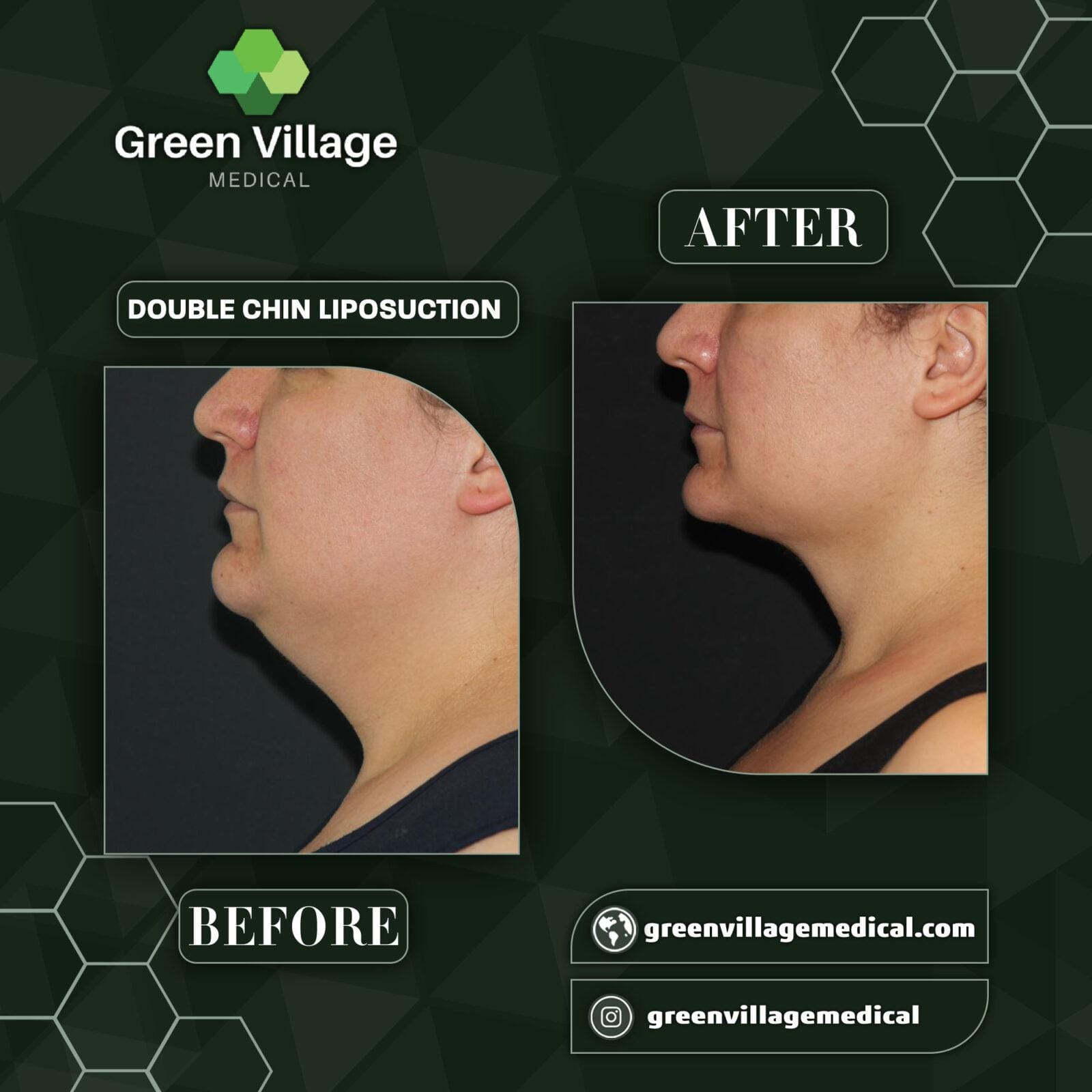 Before After 6