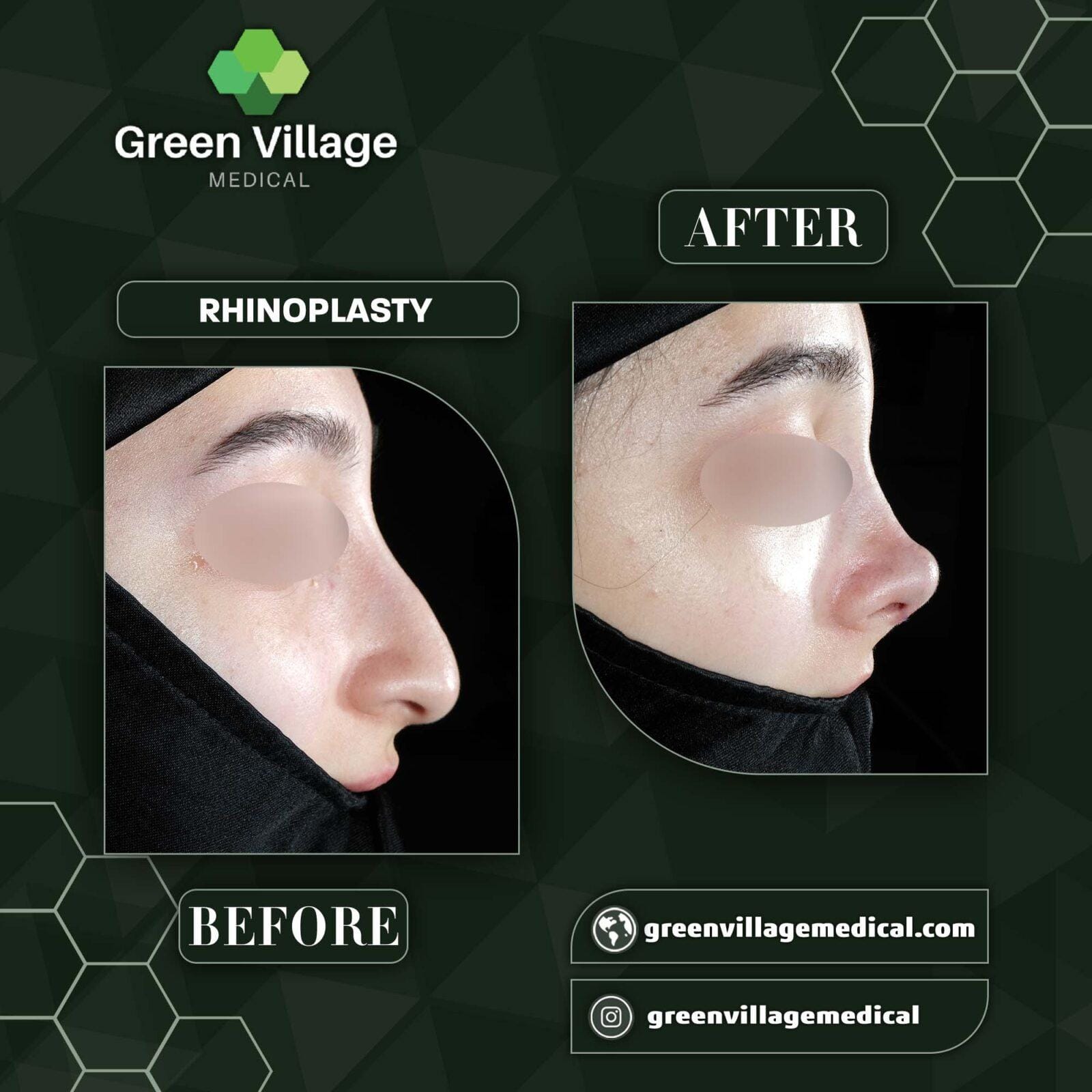 Before After 6