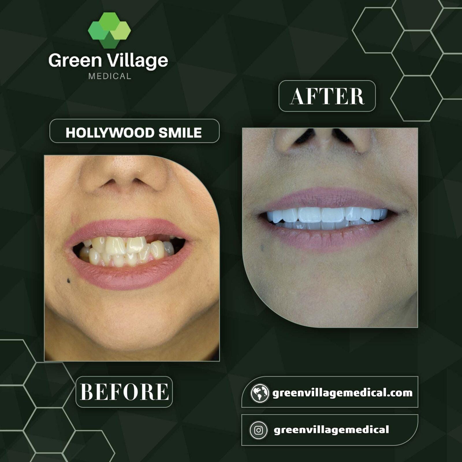 Before After 6