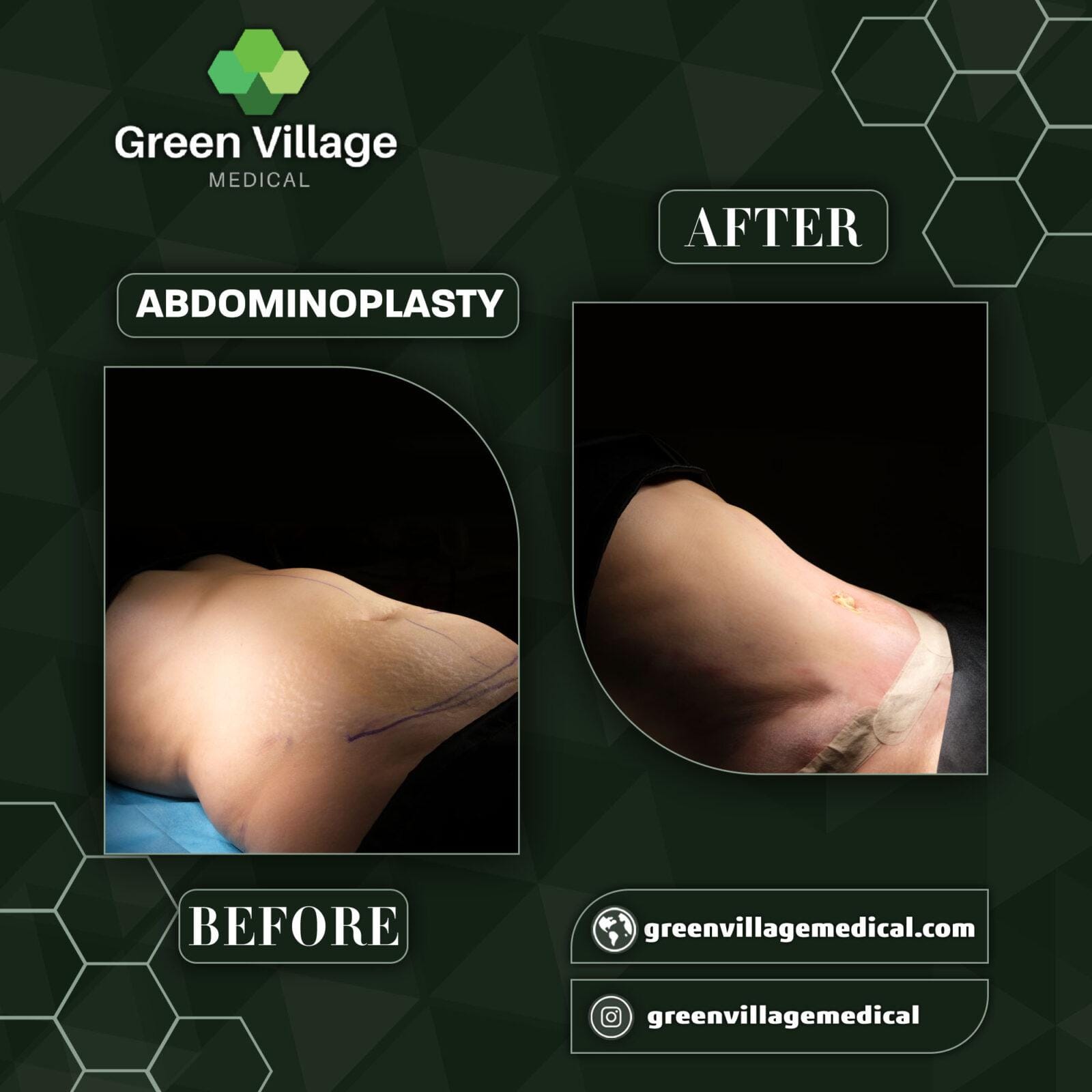 Before After 6