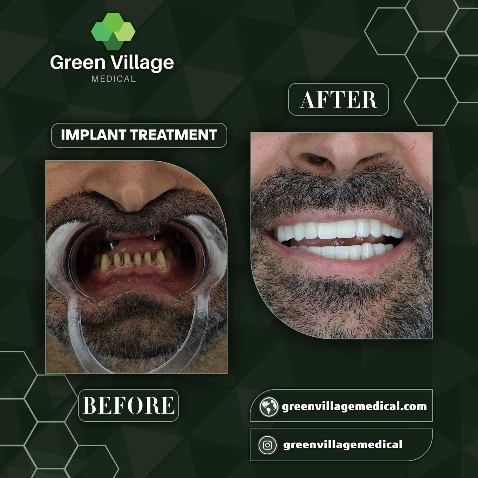 Before After