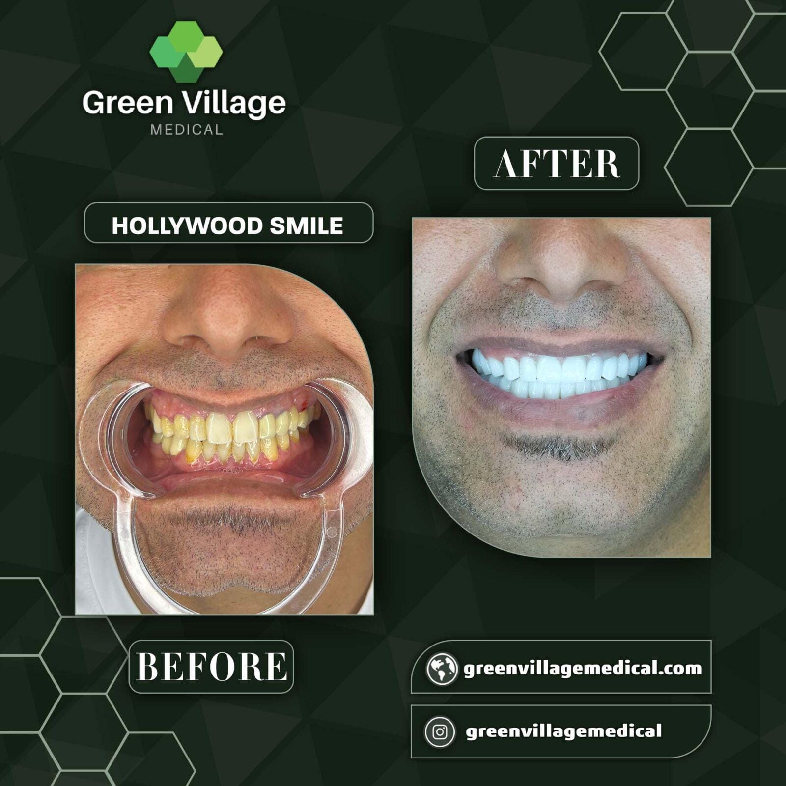 Before After 7