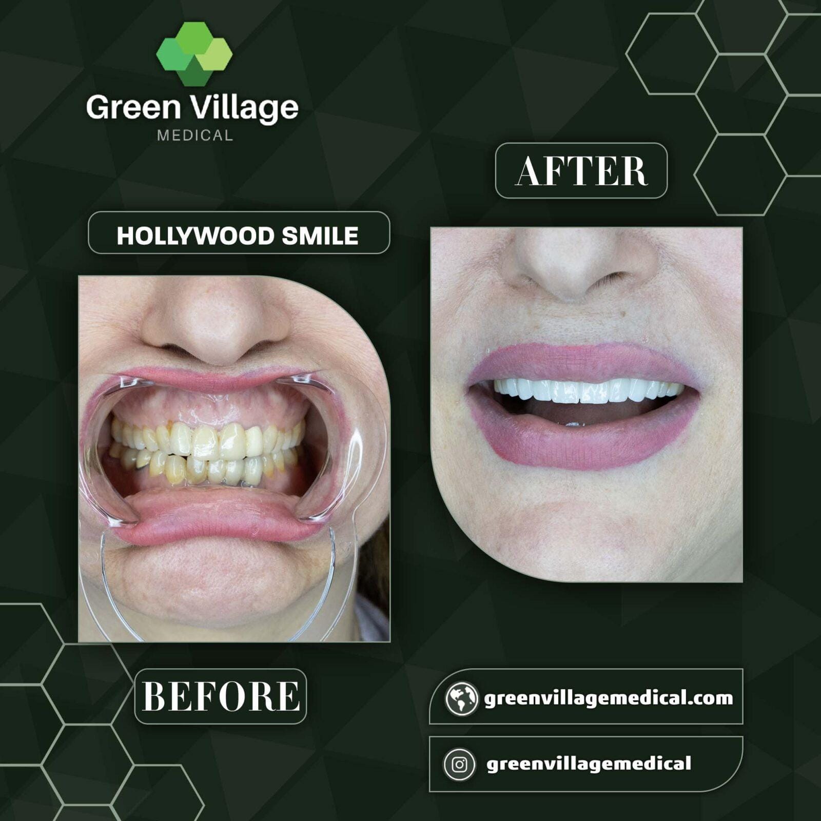 Before After 8