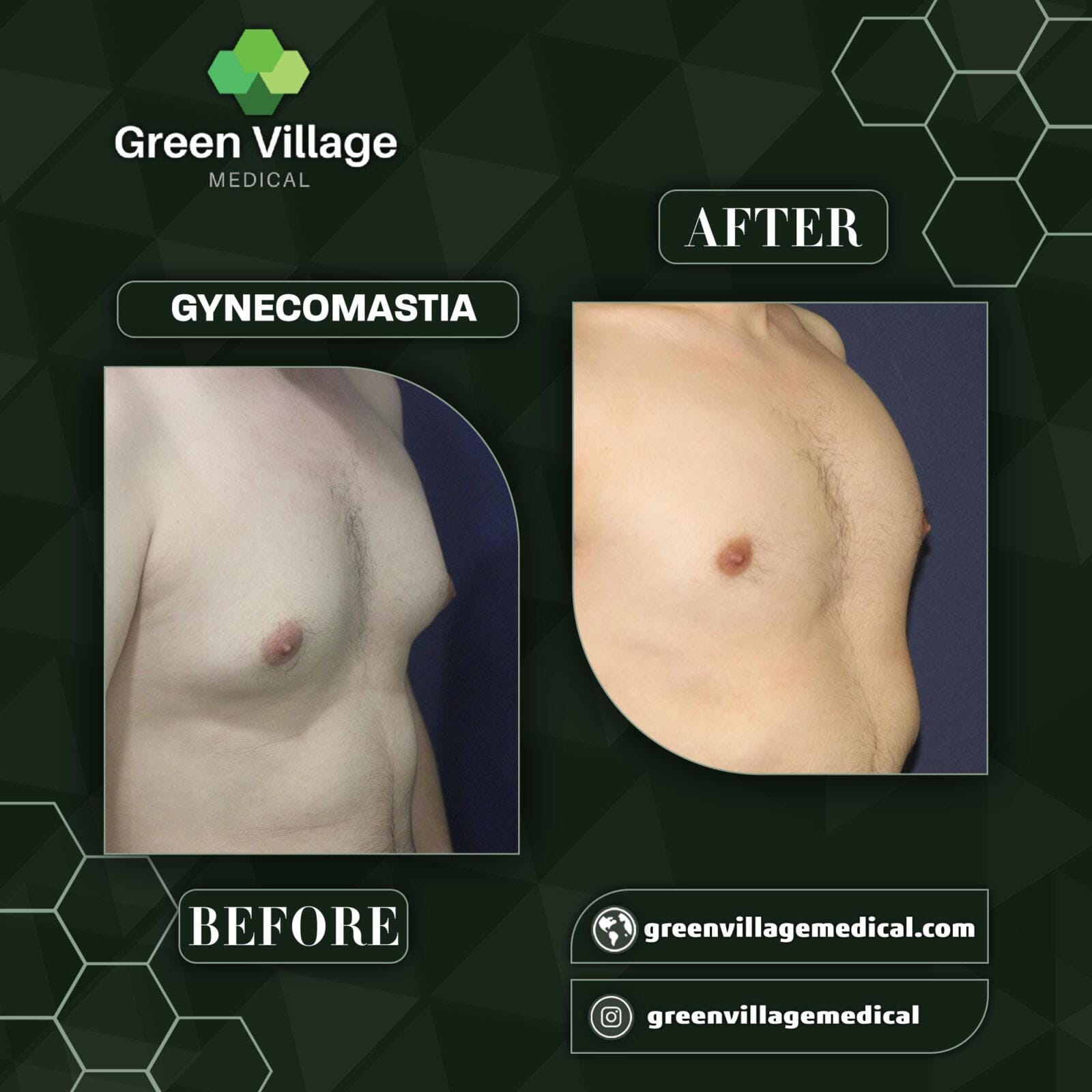 Before After 8